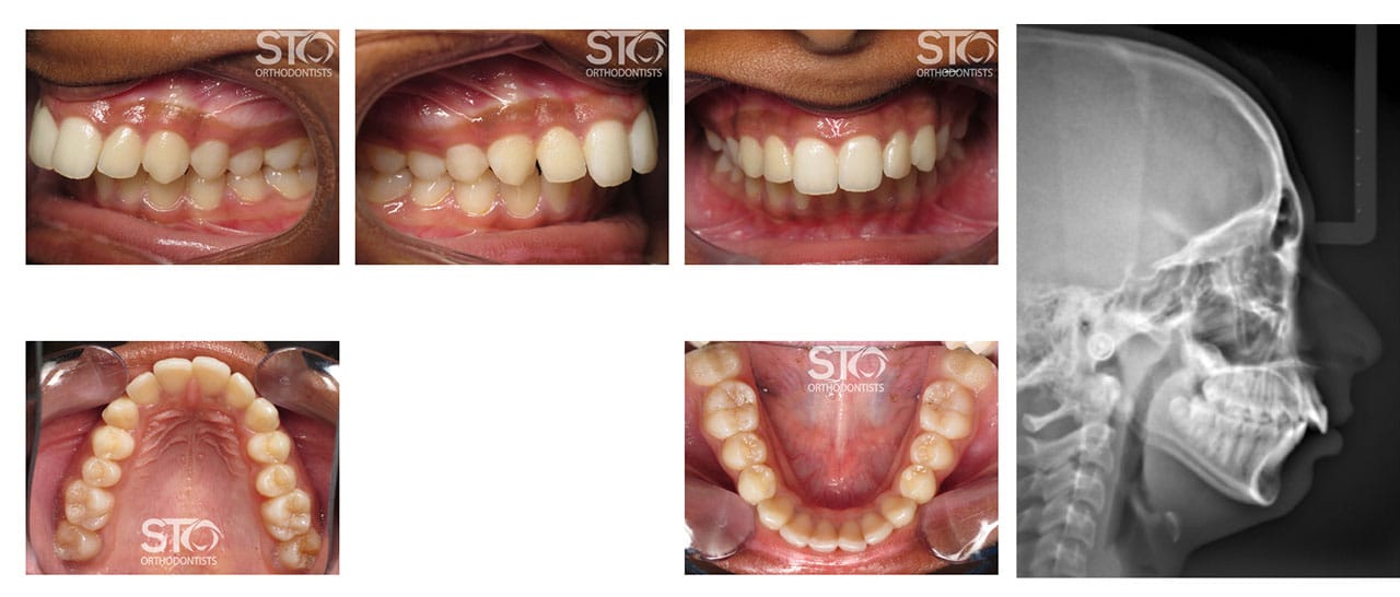 Non-Surgical Orthodontics in Scarborough STO Orthodontists