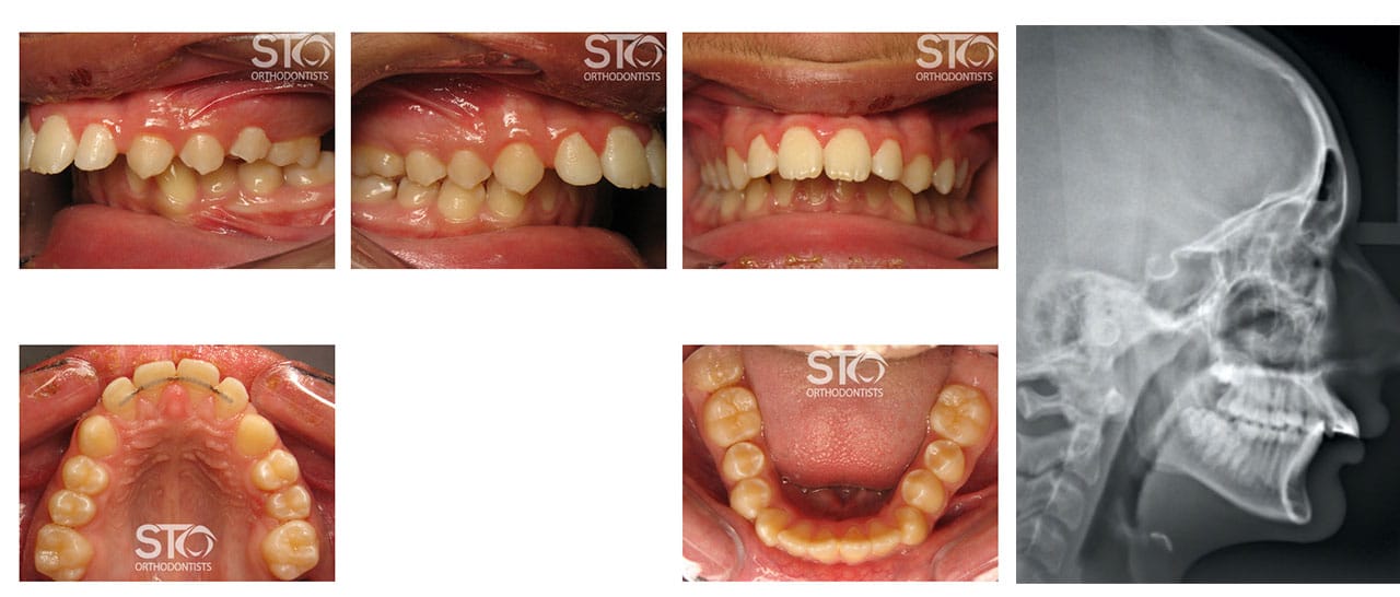 Non-Surgical Orthodontics in Scarborough STO Orthodontists
