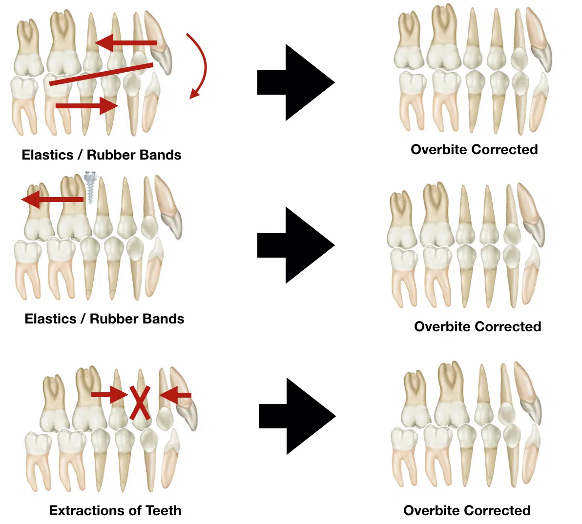 Overbite: Causes, Risks and Treatment — WoodSprings Dentistry